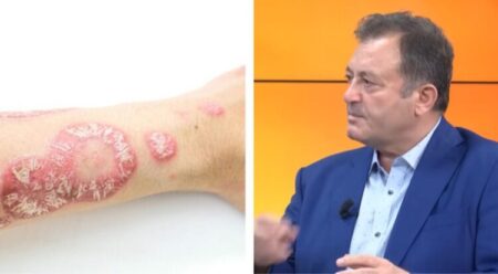 Ylli Merja, Psoriaza