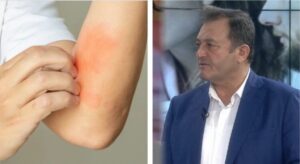 Ylli Merja, Anemia