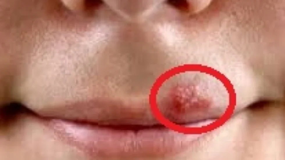 3 metoda që zhdukin herpesin në buzë brenda ditës